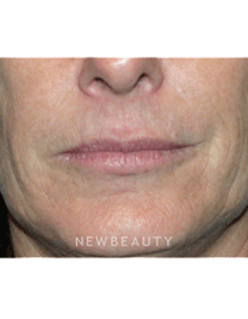 Dr Kelly Bomer Injectable Fillers - Before