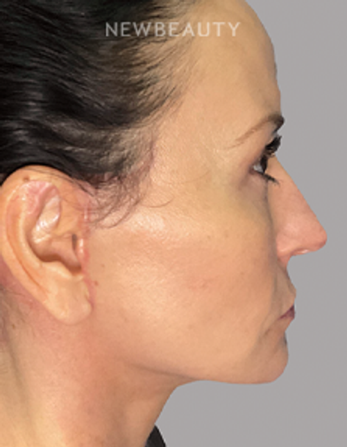 Dr. Philippe Capraro - Facelift at 40 - 35342372 - After