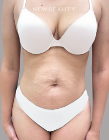 Dr. Daniel Crane - Tummy Transformation - 44688571 - Before