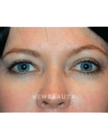 Dr. Kelly Bomer Eyelift - After