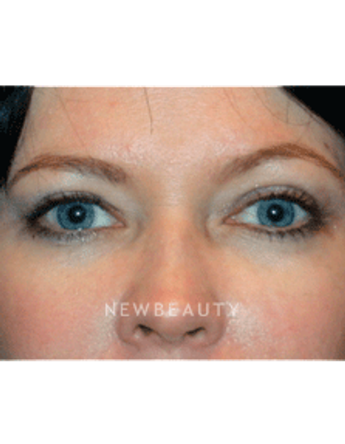 Dr. Kelly Bomer Eyelift - After