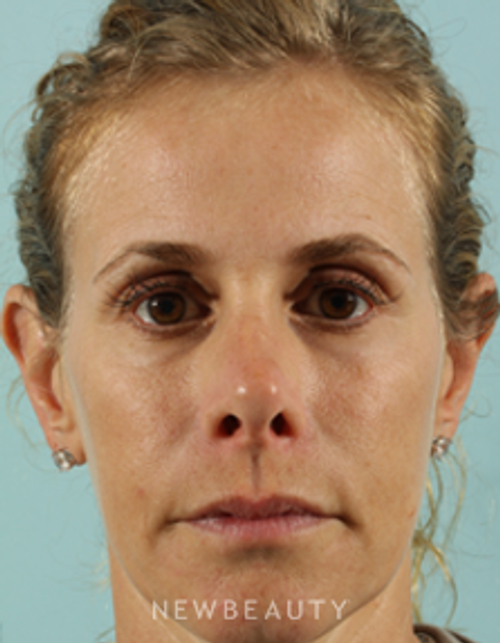 Dr. Marina Peredo - Sculptra - Before