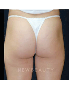 Dr. Kenneth Beer Smoothshapes - After