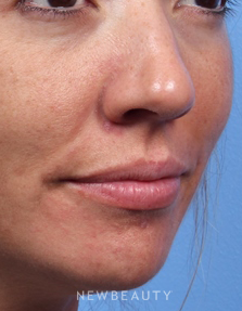 Dr. Kelly Bomer - Lip Filler - Before