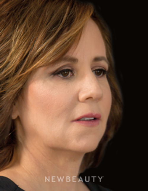 Dr. Janet Allenby - The “Liquid Lift” - After