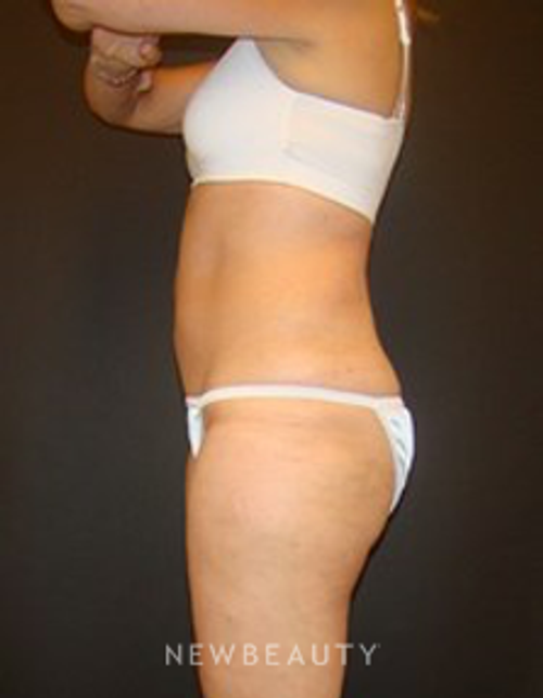 Dr. Joel Schlessinger - Coolsculpting - After