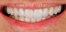 Dr. Husam Almunajed - Veneers - 32080966 - After