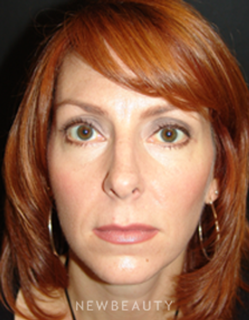 Dr. Mokhtar Asaadi Eyelid Lift - After