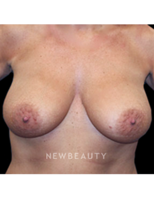 Dr. Christine Hamori - A Natural, Noticeable Change - Before