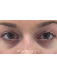 Dr. Julie Russak Injectables & Fillers Belotero - Before