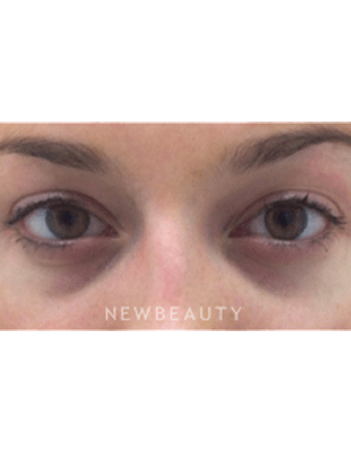 Dr. Julie Russak Injectables & Fillers Belotero - Before
