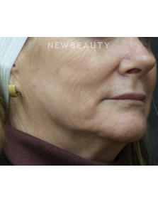 Dr. Jody Levine - Injectables and Fillers - Before