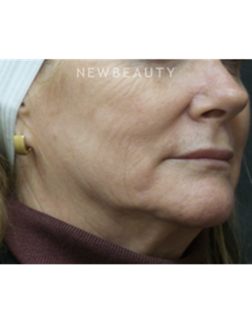 Dr. Jody Levine - Injectables and Fillers - Before