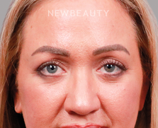 Dr. Peter Vonu-Blepharoplasty-44687802 - After