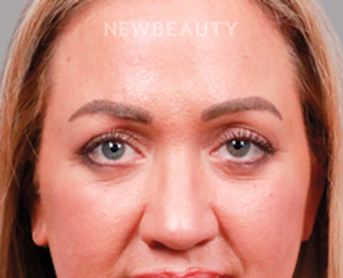 Dr. Peter Vonu-Blepharoplasty-44687802 - After