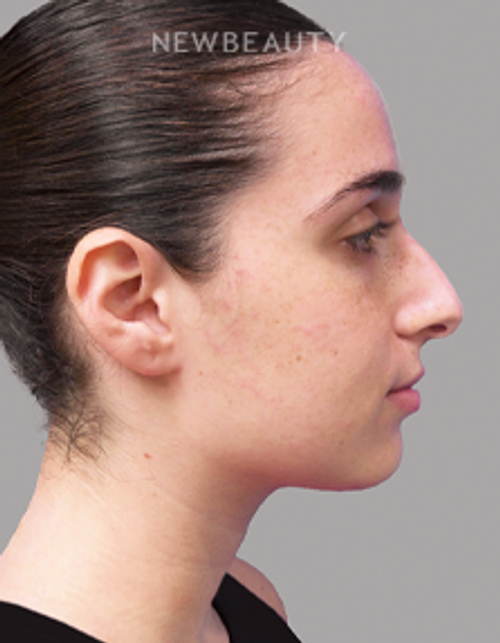 Dr. Michael A. Epstein - Natural-Looking Results - 33109401 - Before