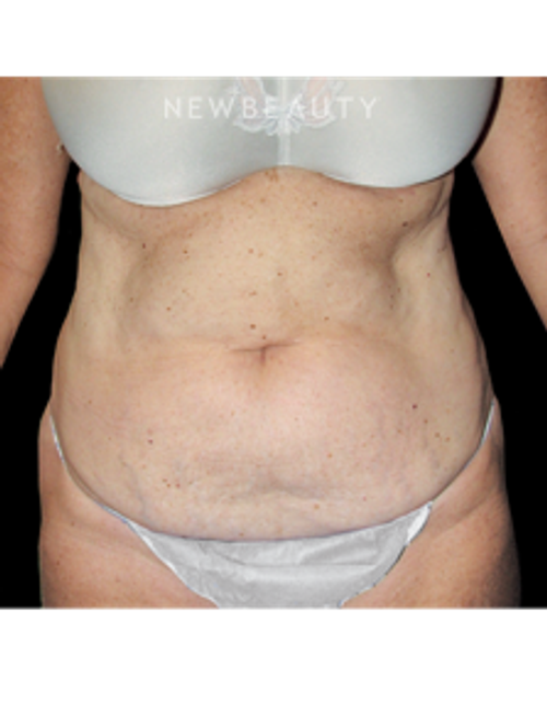 Dr. Bryan W. Gawley - Fit and Trim Results - Before