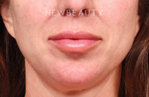 Dr. James Bouzoukis – Lip Enhancement, Cheek Augmentation and Restylane – 52911067 - After