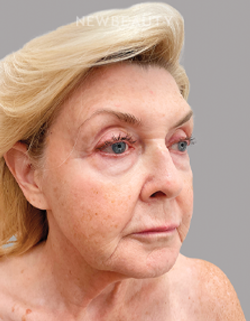 Dr. Daniel Schlessinger – Injectables And Fillers and Lasers – 53105363 - Before