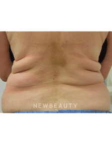 Dr. Julie Russak Fat Melters - Before
