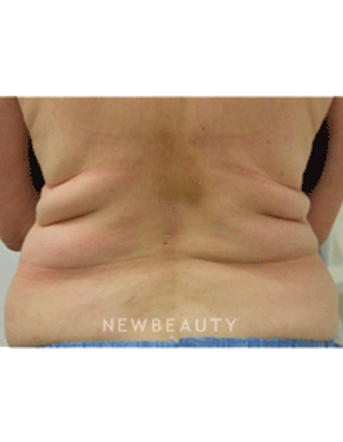 Dr. Julie Russak Fat Melters - Before