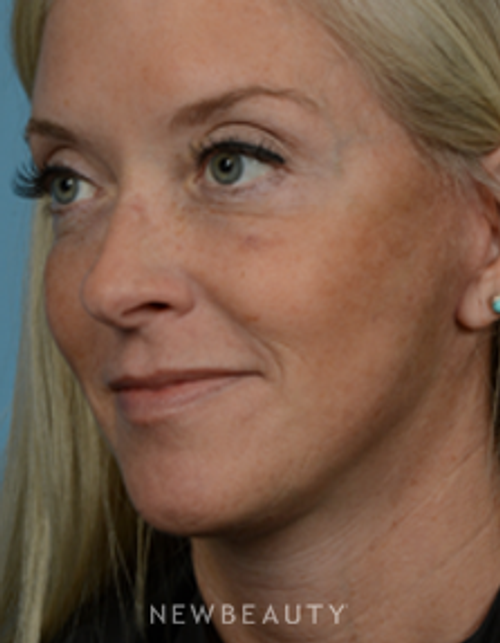 Dr. Jeffrey Wise - Lower Facelift - After