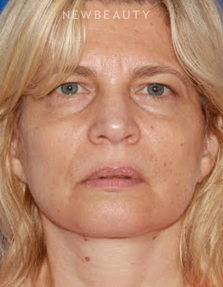 Dr. Konstantin Vasyukevich - Upper and Lower Blepharoplasties - Before