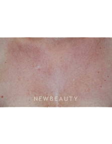 Dr. Beer Laser Treatment - After