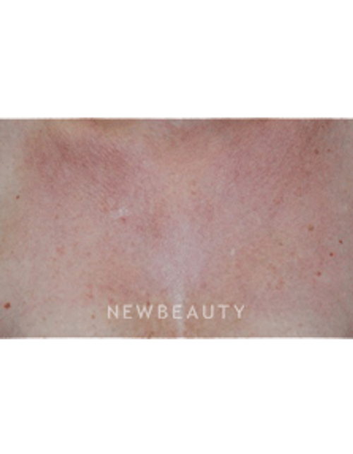Dr. Beer Laser Treatment - After
