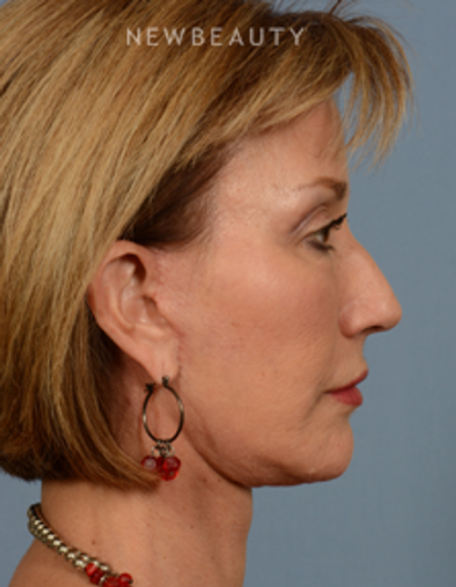 Dr. Bryan W. Gawley - Facial Rejuvenation - After