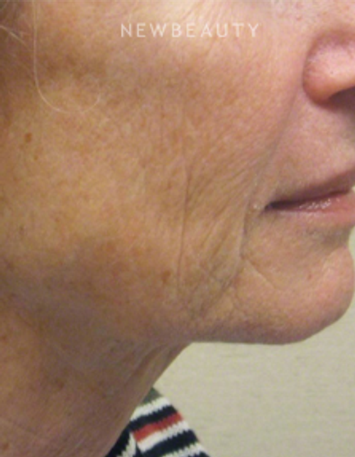 Dr. Kally Papantoniou - Ulthera - After