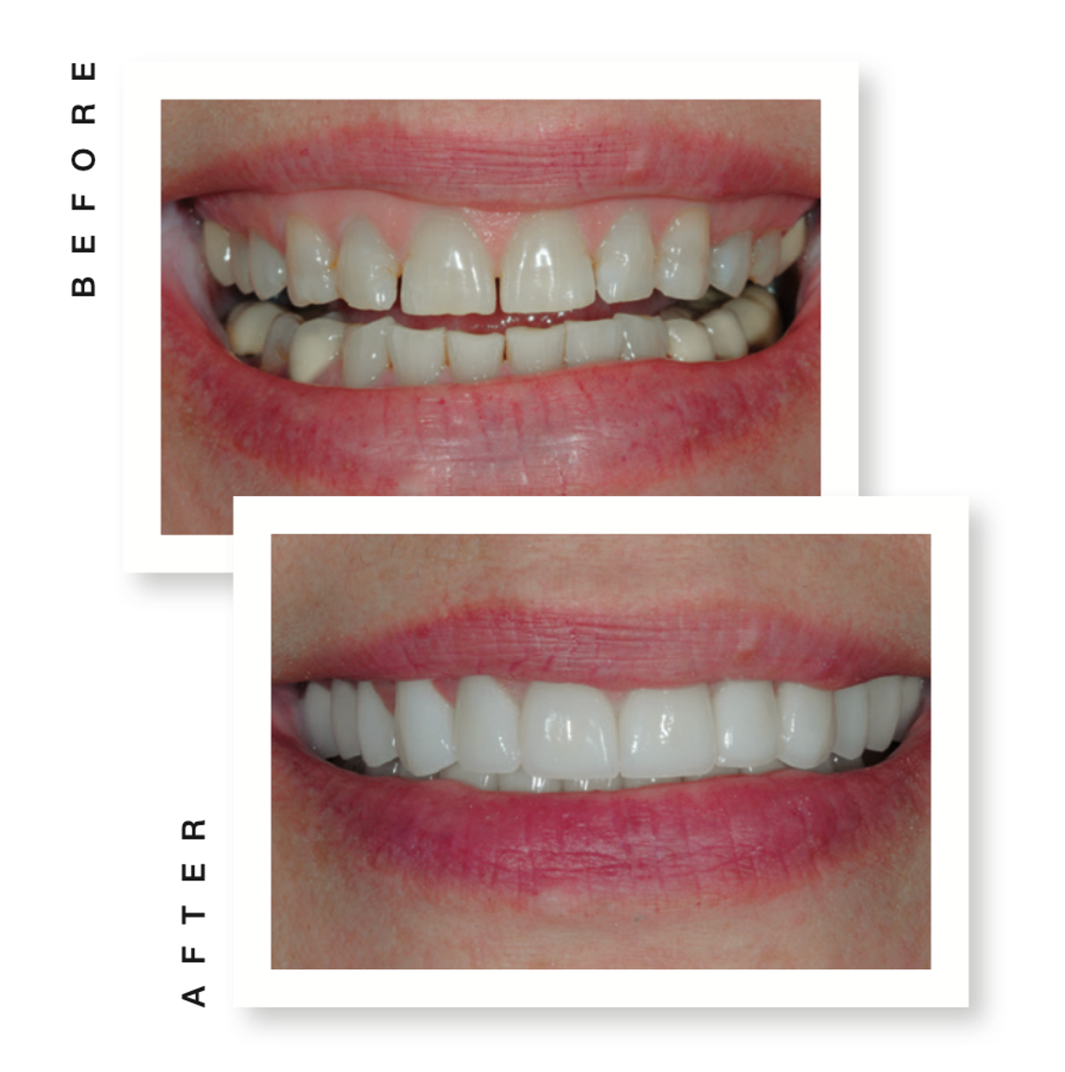 smile before and after