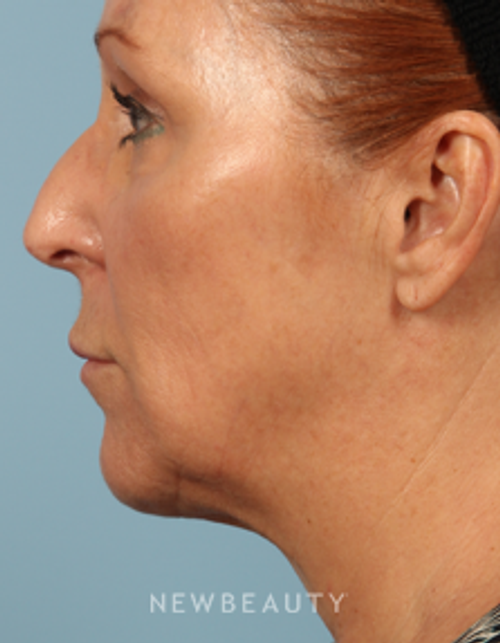 Dr. Carmen M. Kavali - Contour Correction - After