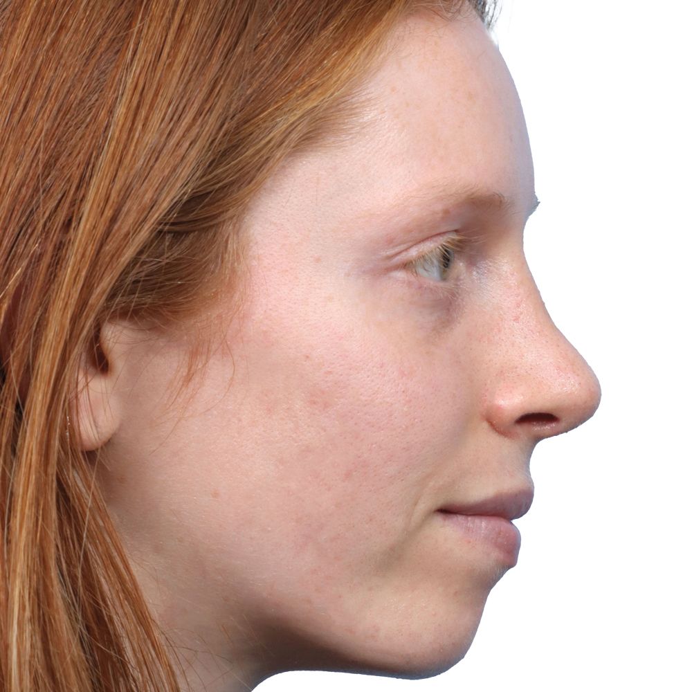 Rhinoplasty After