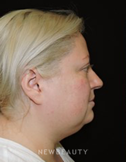 Dr. Joel Schlessinger - SmartLipo - Before