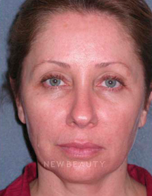 Dr. Min Ahn Facelift, Necklift - Before