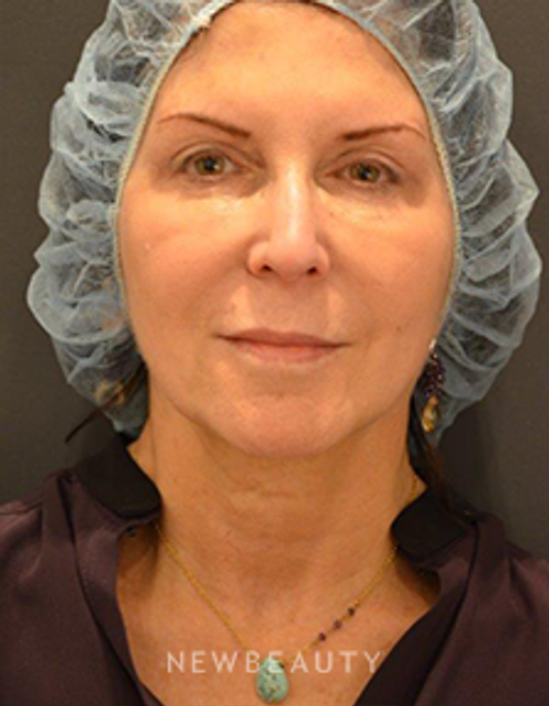 Dr. B. Aviva Preminger - Chemical Peel & Injectables - After