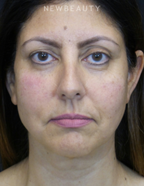 Dr. Adam Summers - Facelift - After