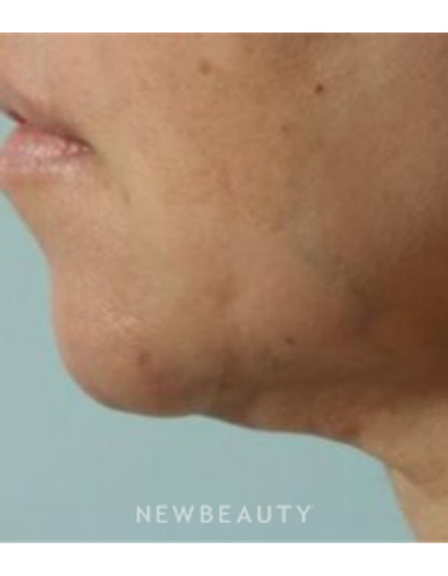 Dr. Marina Peredo - Necklift - After