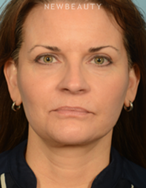 Dr. Bryan Gawley - Facelift - After