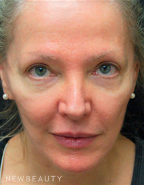 Dr. Mokhtar Asaadi Browlift - Before
