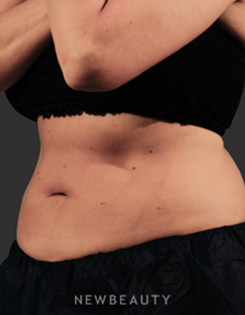 Dr. Marina Peredo Fat Melters - CoolSculpting - After