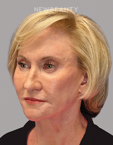 Dr. Paul Afrooz – Beautiful Transformation – 36269784 - After