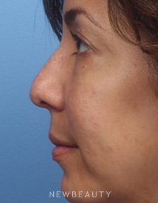 Dr. Kelly Bomer - Nonsurgical Rhinoplasty - Before