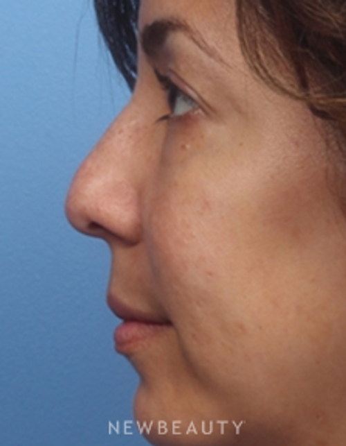 Dr. Kelly Bomer - Nonsurgical Rhinoplasty - Before