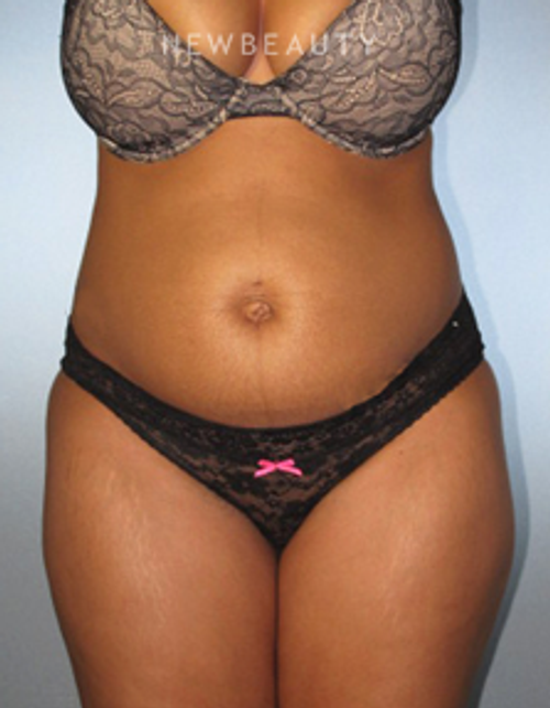 Dr. German Newall - Feminine Rejuvenation - Before