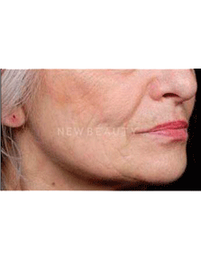 Dr. Ruth Hillelson Thermage - After