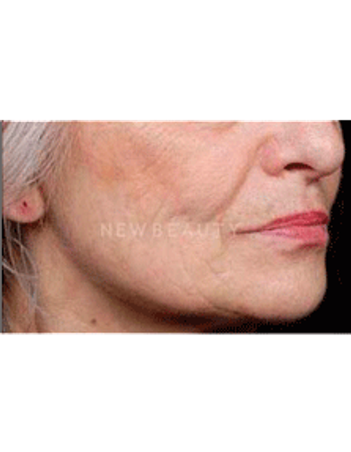 Dr. Ruth Hillelson Thermage - After