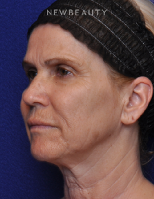 Dr. Alan J. Durkin - Facelift - Before
