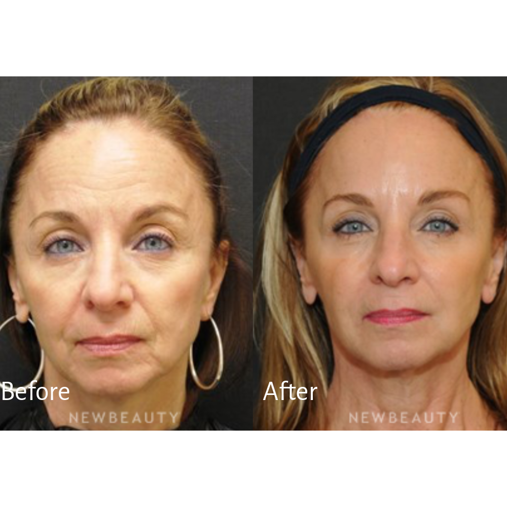 Younger-Looking Skin